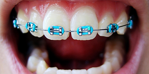 Apparecchi dentali fai da te, la nuova tendenza online